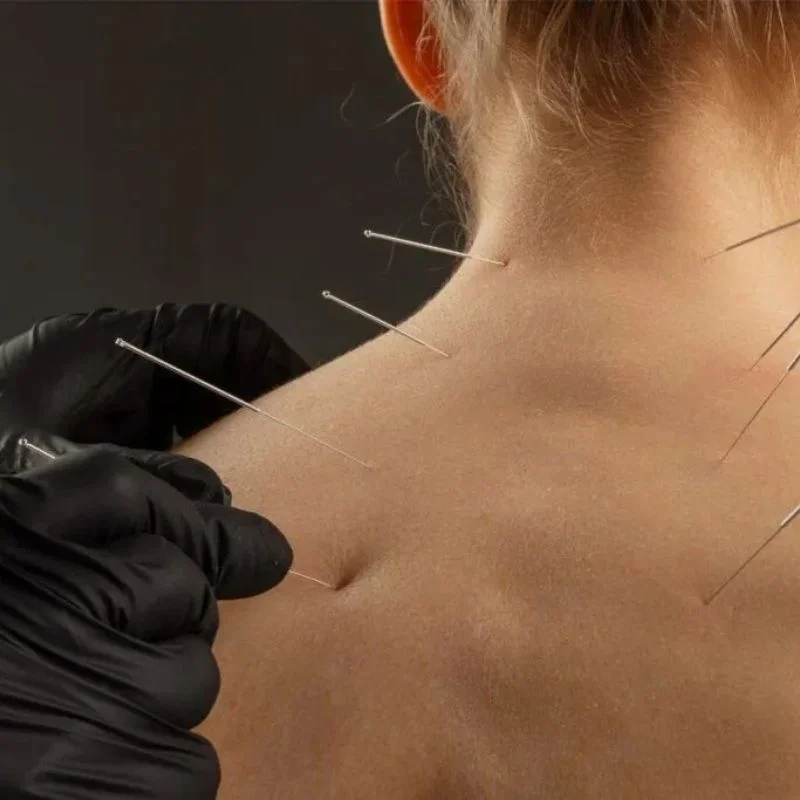 acupuncture needles placed on neck and shoulder for pain relief in Whitby