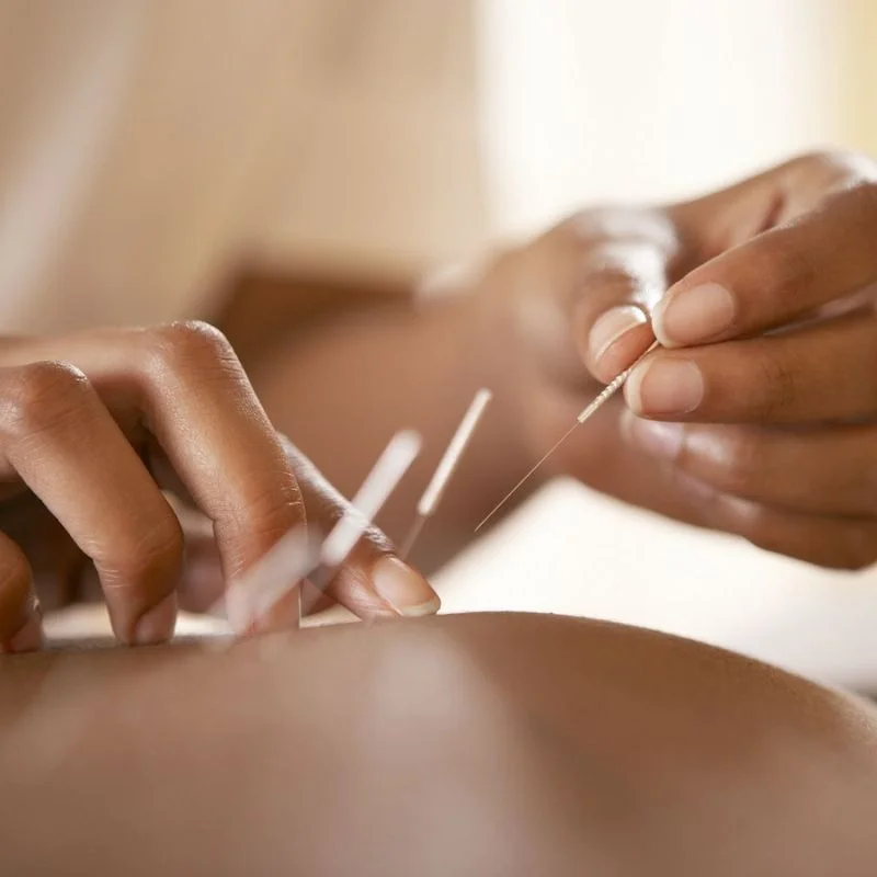 acupuncturist inserting needles for pain relief and rehabilitation in Whitby